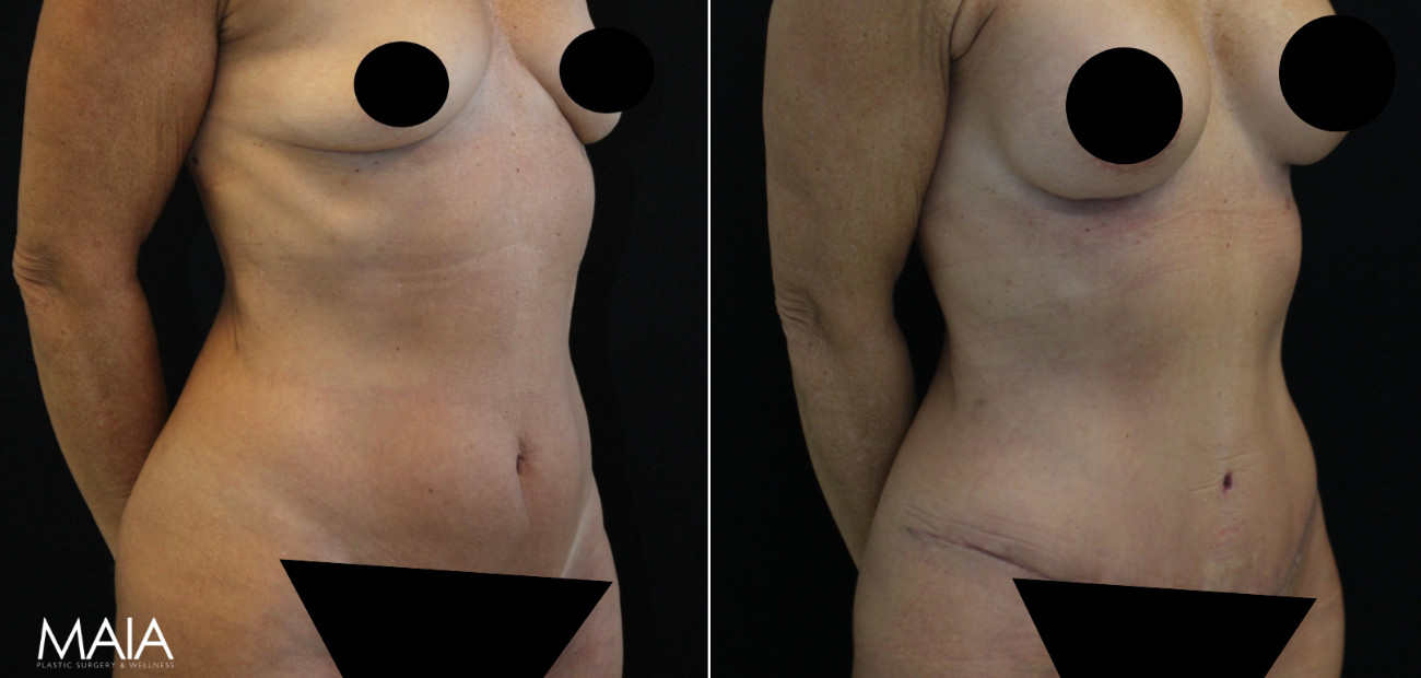 Side-by-side photos show a woman's torso before and after a surgical procedure, with visible changes in contour and scars. Sensitive areas are censored for privacy.