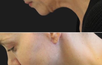 49 year-old patient before and 6 months after a facelift, neck lift, upper and lower blepharoplasty, temple lift, fat grafting, nanofat grafting, and buccal fat pad removal.