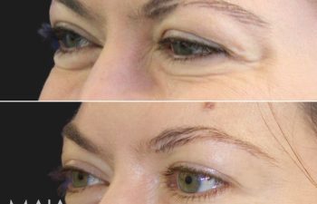 42 Year-Old Before and 2 Weeks After Botox