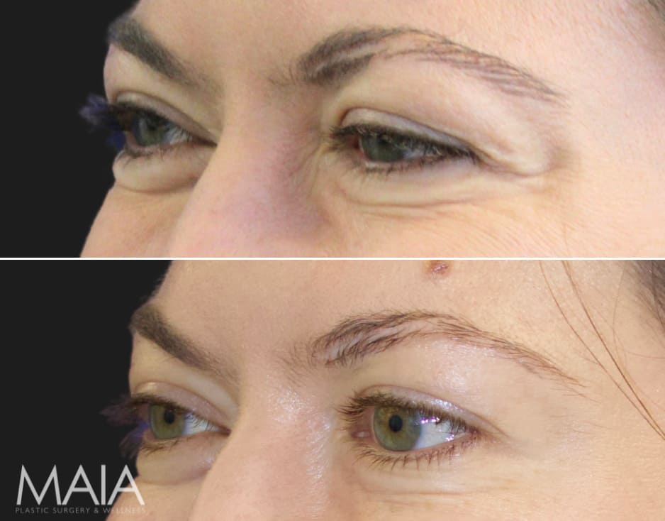 42 Year-Old Before and 2 Weeks After Botox