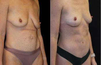 Side-by-side comparison of a woman's torso before and after cosmetic surgery, showing changes in breast shape and abdominal contour.