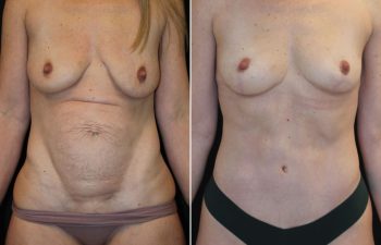Side-by-side photo showing a woman’s torso before and after cosmetic surgery, with visible reduction of abdominal skin and contour changes.