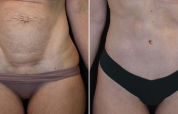 Before and after photos showing abdominal appearance; left image with loose skin, right image with smoother, tighter skin, likely post-cosmetic procedure.