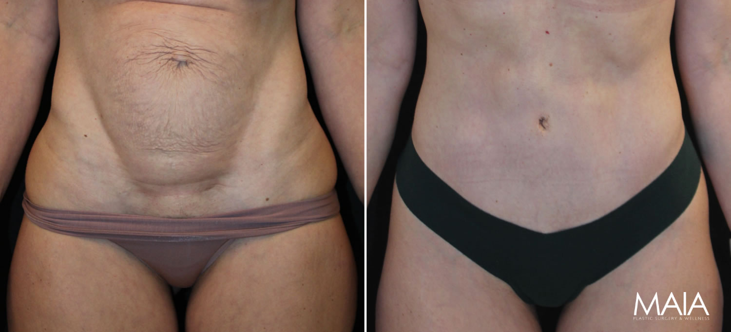 Before and after photos showing abdominal appearance; left image with loose skin, right image with smoother, tighter skin, likely post-cosmetic procedure.