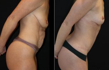 Side-by-side comparison of a woman before and after cosmetic surgery, showing changes in breast and abdominal appearance.