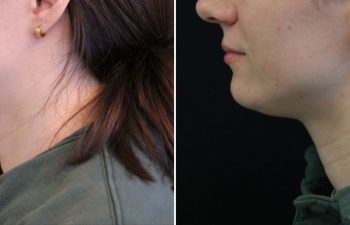 34 year-old before and 3 sessions after Morpheus8