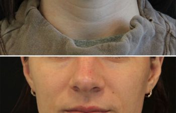 34 year-old before and 3 sessions after Morpheus8