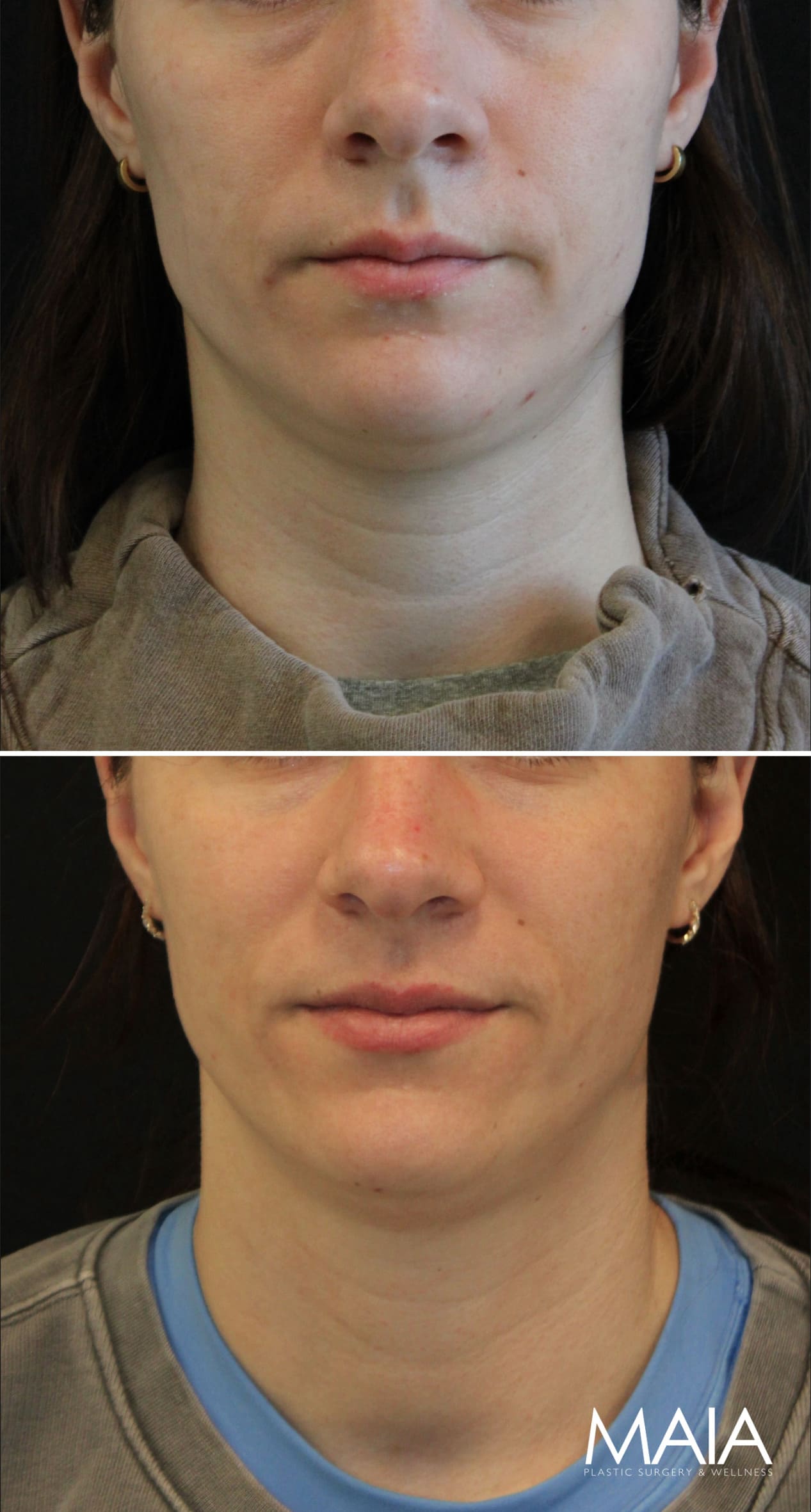 34 year-old before and 3 sessions after Morpheus8