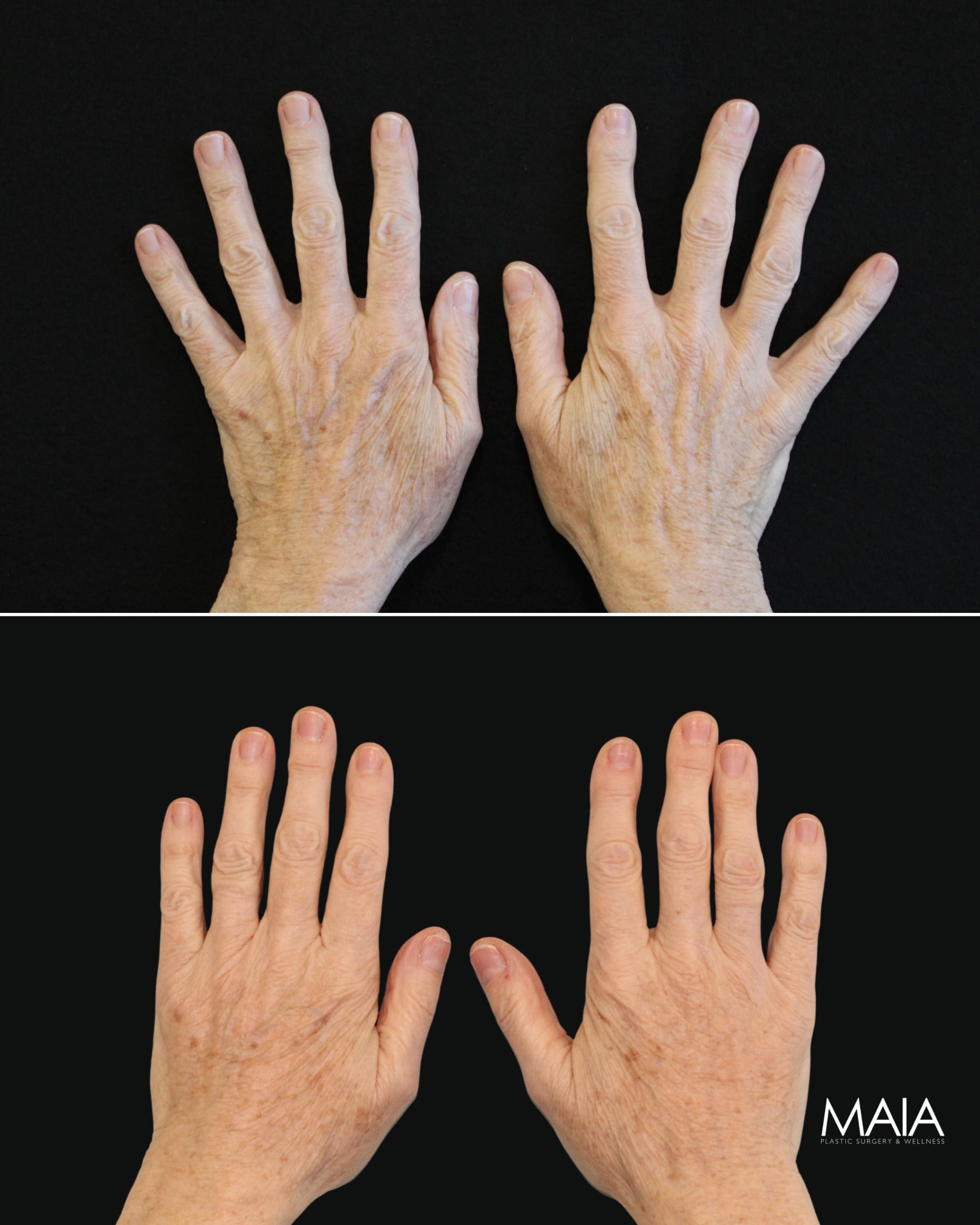 60 year-old before and two months after radiesse