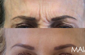 71 year-old before and 2 weeks after Xeomin