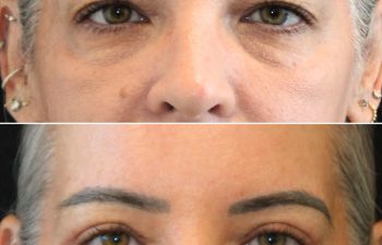Close-up before-and-after photos of a person's face, showing reduced wrinkles and smoother skin around the eyes in the after image.