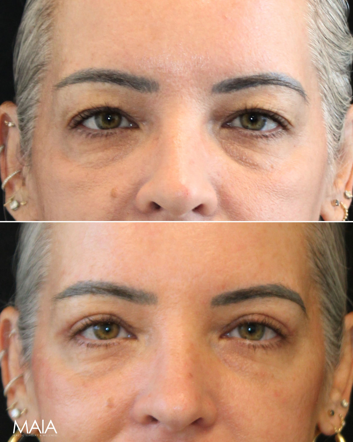 Close-up before-and-after photos of a person's face, showing reduced wrinkles and smoother skin around the eyes in the after image.