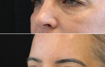 Side-by-side images showing a person's face before (top) and after (bottom) an eyelid cosmetic procedure, highlighting reduced eyelid sagging.
