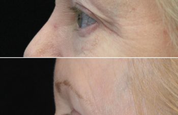 Side-by-side close-up images showing the eye and upper cheek area of a person's face before (top) and after (bottom) a cosmetic procedure, with visible reduction in fine lines and wrinkles.