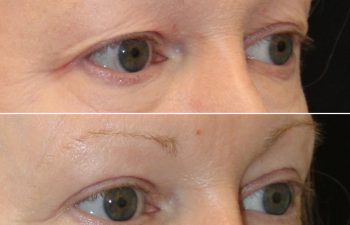 Close-up of a person's eyes in two images; the top shows drooping eyelids, the bottom shows lifted, firmer eyelids after a cosmetic procedure.