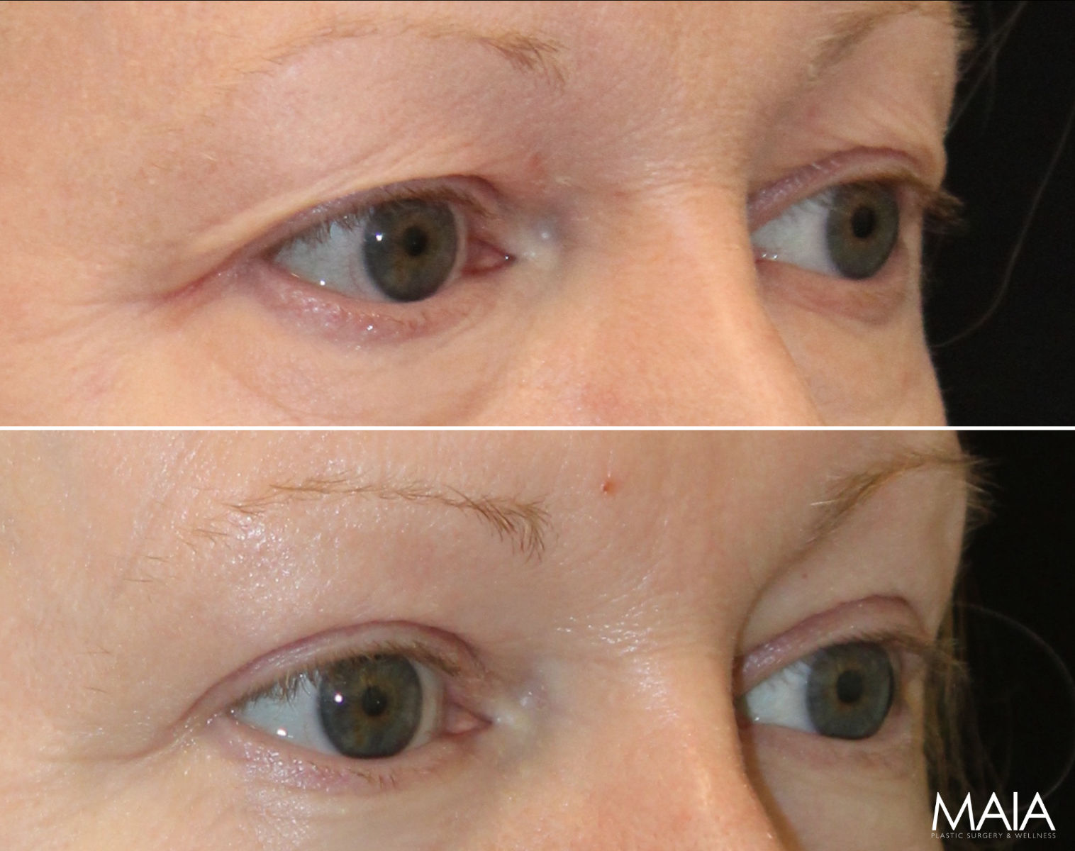 Close-up of a person's eyes in two images; the top shows drooping eyelids, the bottom shows lifted, firmer eyelids after a cosmetic procedure.