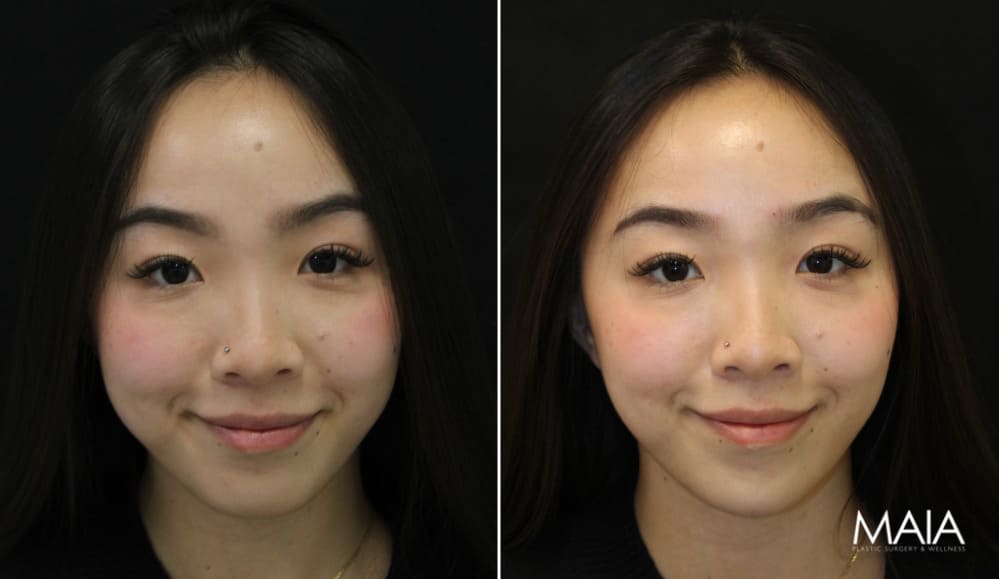 25 year-old before and immediately after chin filler