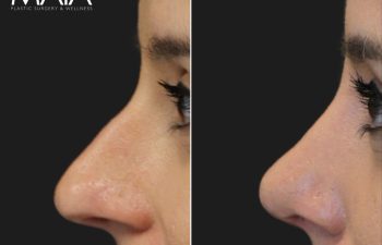 35 year-old before and 8 weeks after rhinoplasty