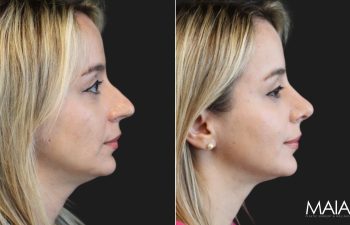 35 year-old before and 8 weeks after rhinoplasty