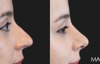 35 year-old before and 8 weeks after rhinoplasty