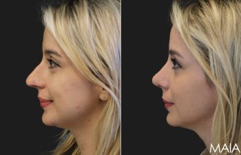 35 year-old before and 8 weeks after rhinoplasty