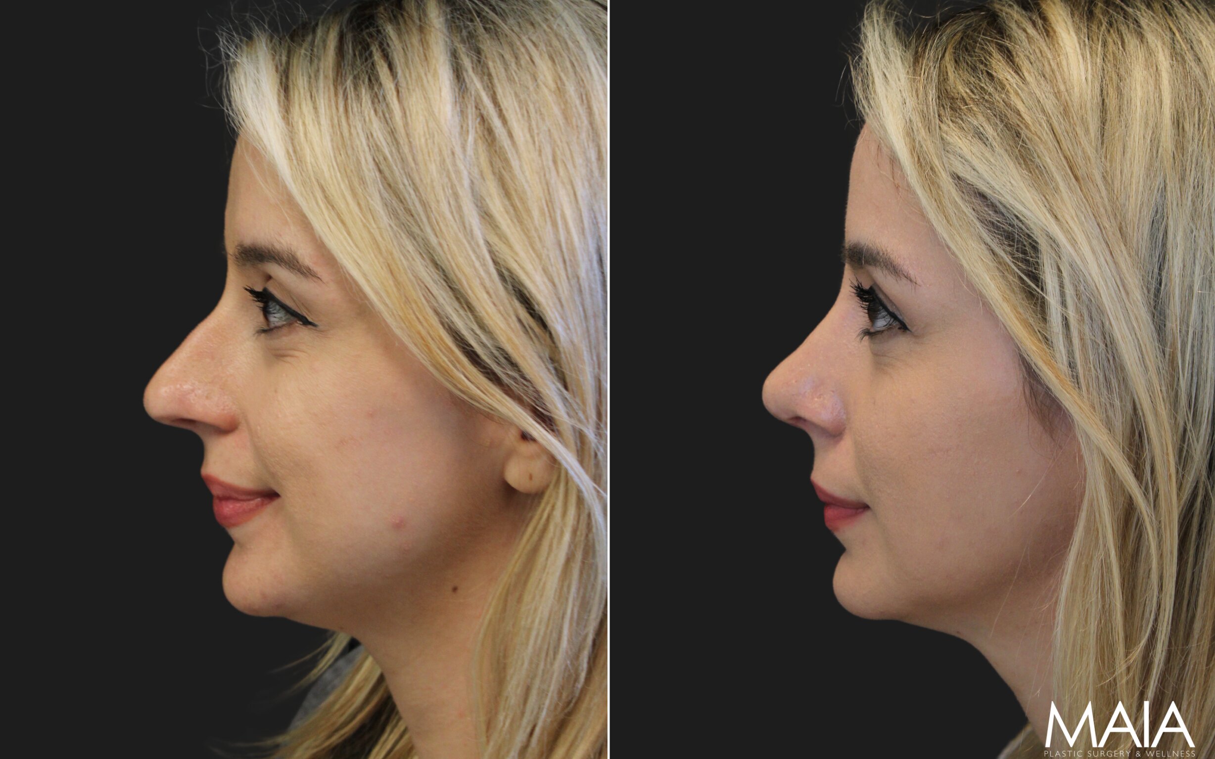 35 year-old before and 8 weeks after rhinoplasty