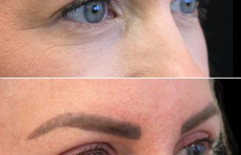 Close-up, side-by-side comparison of a person's eyebrows and eye area before (top) and after (bottom) a cosmetic eyebrow procedure.