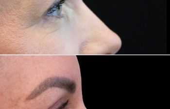 Side-by-side photos of a person's face in profile showing eyebrow and skin changes before (top) and after (bottom) a cosmetic procedure.