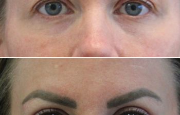 Close-up of a person's eyes and eyebrows, shown in two images: the top image is before, and the bottom image is after a cosmetic eyebrow enhancement procedure.