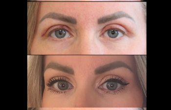 42 year old, eyelid lift (2 month post-op) healing journey