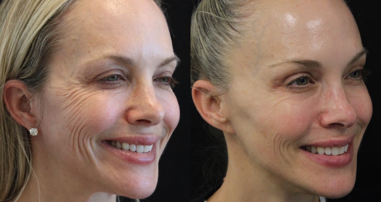 Before and After Neuromodulators + 3 Sessions of Morpheus8