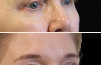 Side-by-side comparison shows a woman's face before and after a cosmetic procedure, with smoother skin, enhanced eyebrows, and improved overall appearance in the after image.