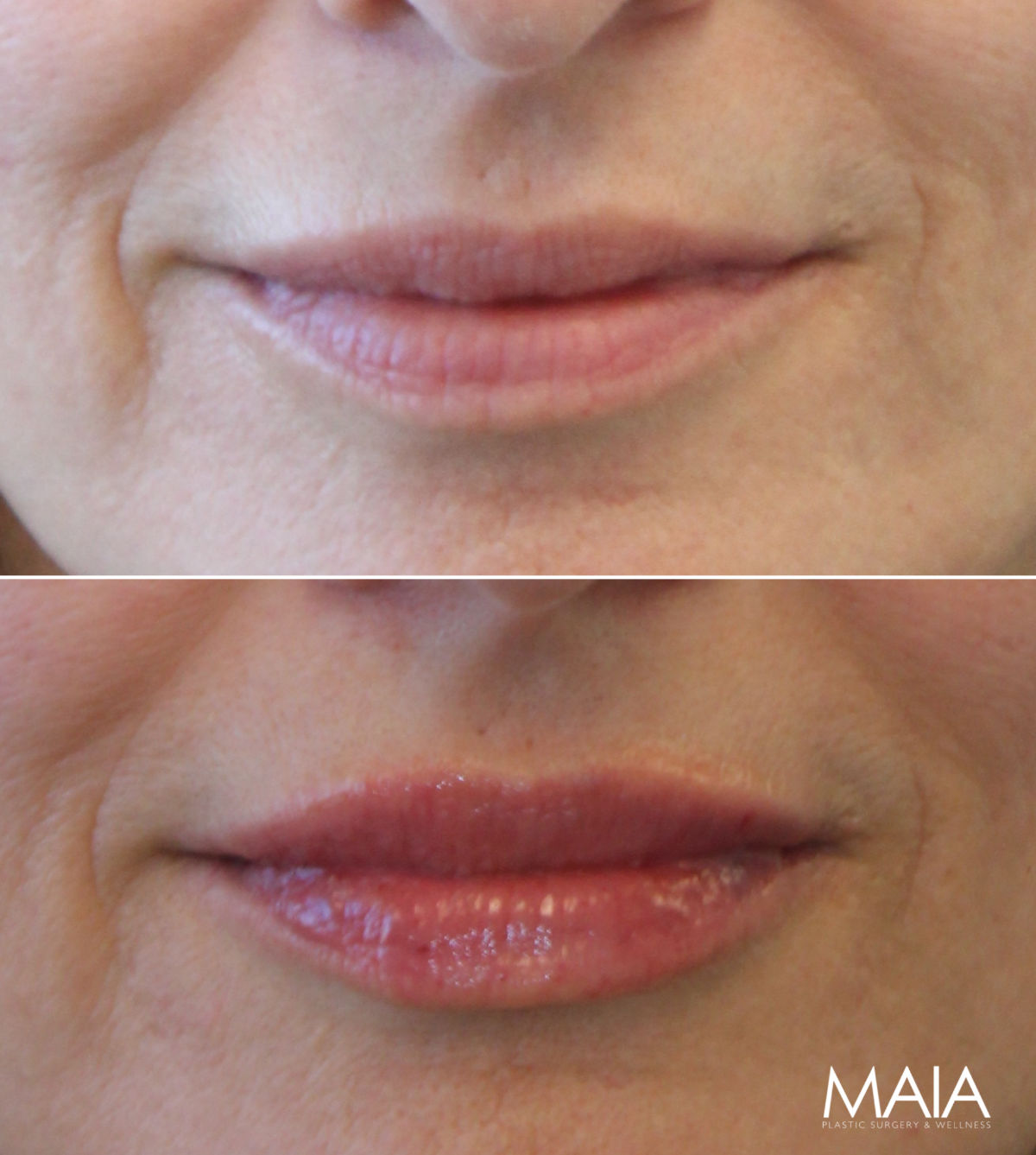 58 year-old before and immediately after lip filler