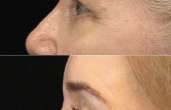 Side-by-side comparison of a woman's face before and after a cosmetic procedure, showing changes in the eye area, eyebrow, and skin texture.