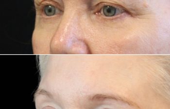 Side-by-side comparison of a woman’s eyes before (top) and after (bottom) a cosmetic procedure, showing smoother skin and reduced wrinkles around the eyes.