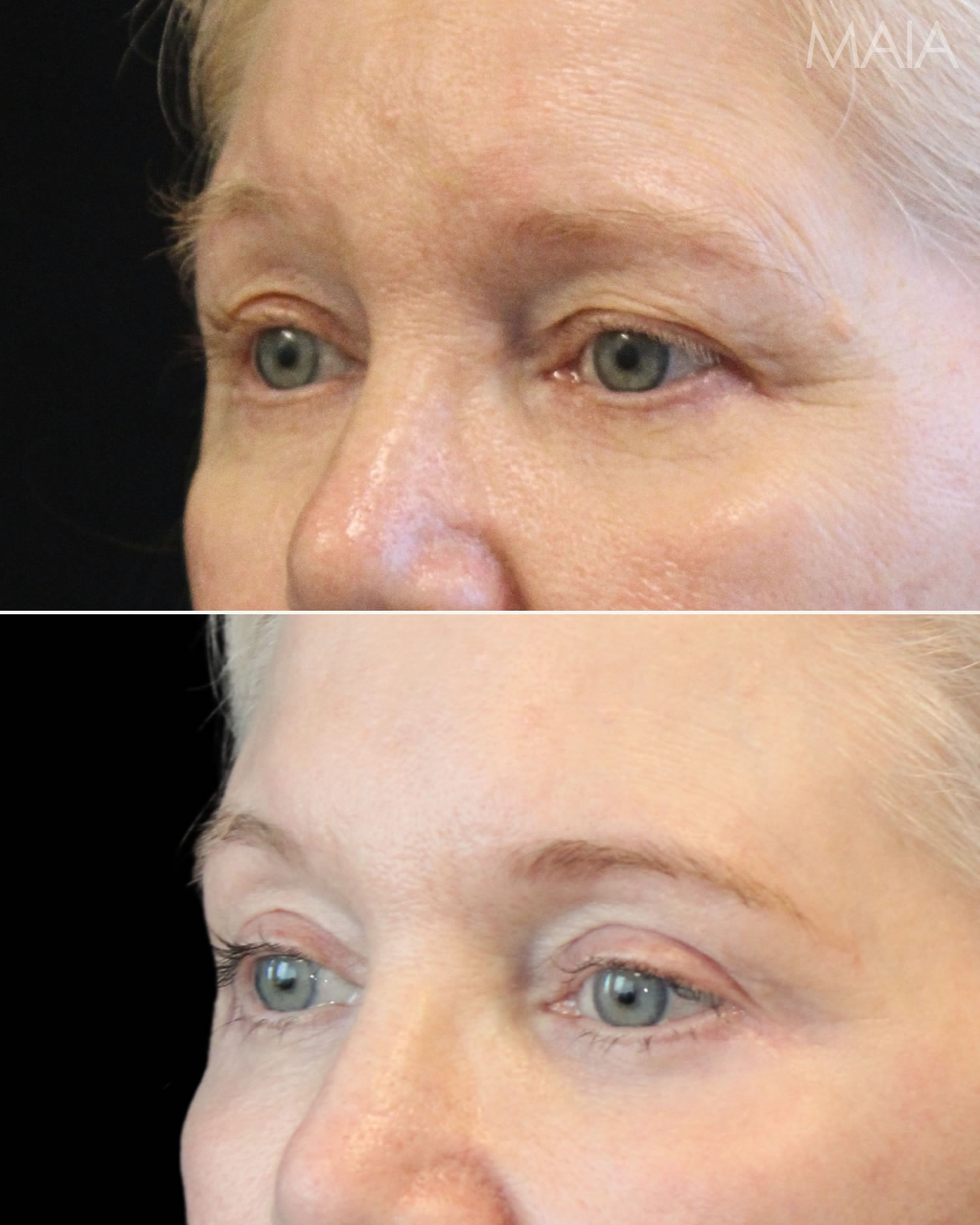 Side-by-side comparison of a woman’s eyes before (top) and after (bottom) a cosmetic procedure, showing smoother skin and reduced wrinkles around the eyes.