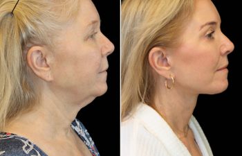 Side-by-side profile photos of a woman before and after a cosmetic procedure, showing a smoother jawline and tightened skin in the after image.