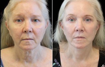 Side-by-side comparison of a woman’s face before and after a cosmetic procedure, showing smoother skin and a more even complexion in the after photo.
