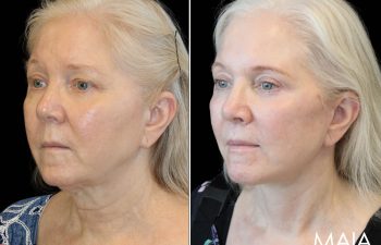 Side-by-side comparison of an older woman before and after a cosmetic procedure, showing reduced wrinkles and tightened skin on her face and neck.