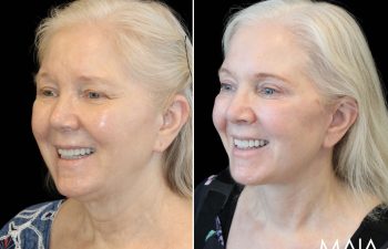 Side-by-side comparison of an older woman before and after a cosmetic procedure, showing smoother skin and a more even complexion in the after photo.