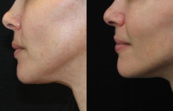 Before and After Neuromodulators + 3 Sessions of Morpheus8