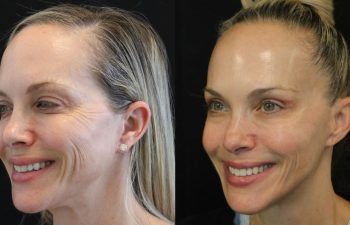 Before and After Neuromodulators + 3 Sessions of Morpheus8