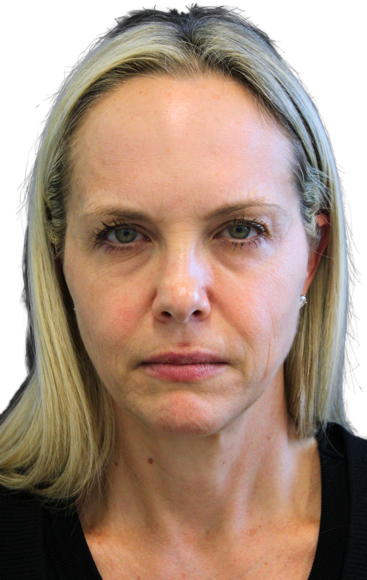 http://woman%20before%20facelift