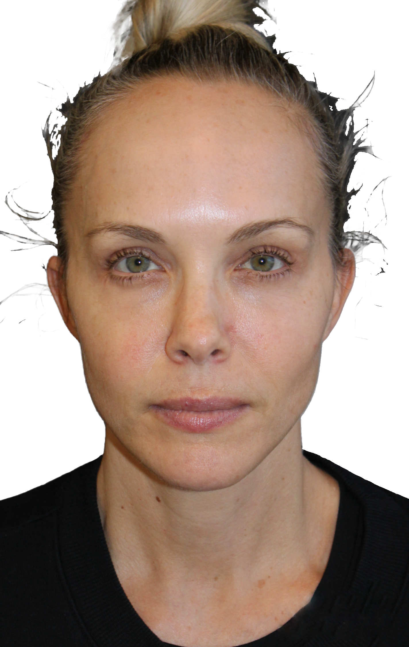 http://woman%20after%20facelift