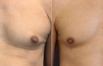 Male Patient, 53 years-old, 3 Months after Nipple Reduction with Dr. Maia in Tysons Corner