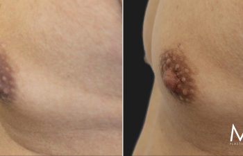 Male Patient, 53 years-old, 3 Months after Nipple Reduction with Dr. Maia in Tysons Corner