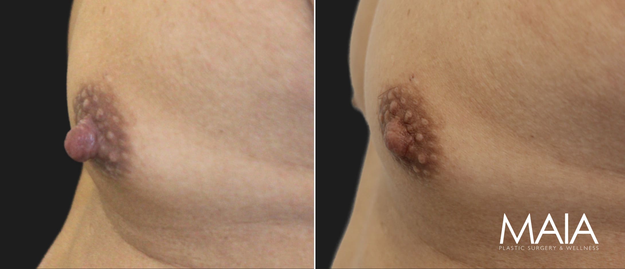 Male Patient, 53 years-old, 3 Months after Nipple Reduction with Dr. Maia in Tysons Corner