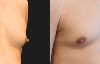 Male Patient, 53 years-old, 3 Months after Nipple Reduction with Dr. Maia in Tysons Corner