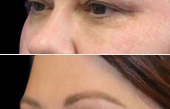 48 year-old patient before and 3 months after an Upper Blepharoplasty (Eyelid Lift), Mini Temple Lift and TCA Peel