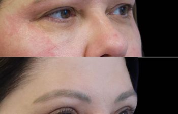 48 year-old patient before and 3 months after an Upper Blepharoplasty (Eyelid Lift), Mini Temple Lift and TCA Peel